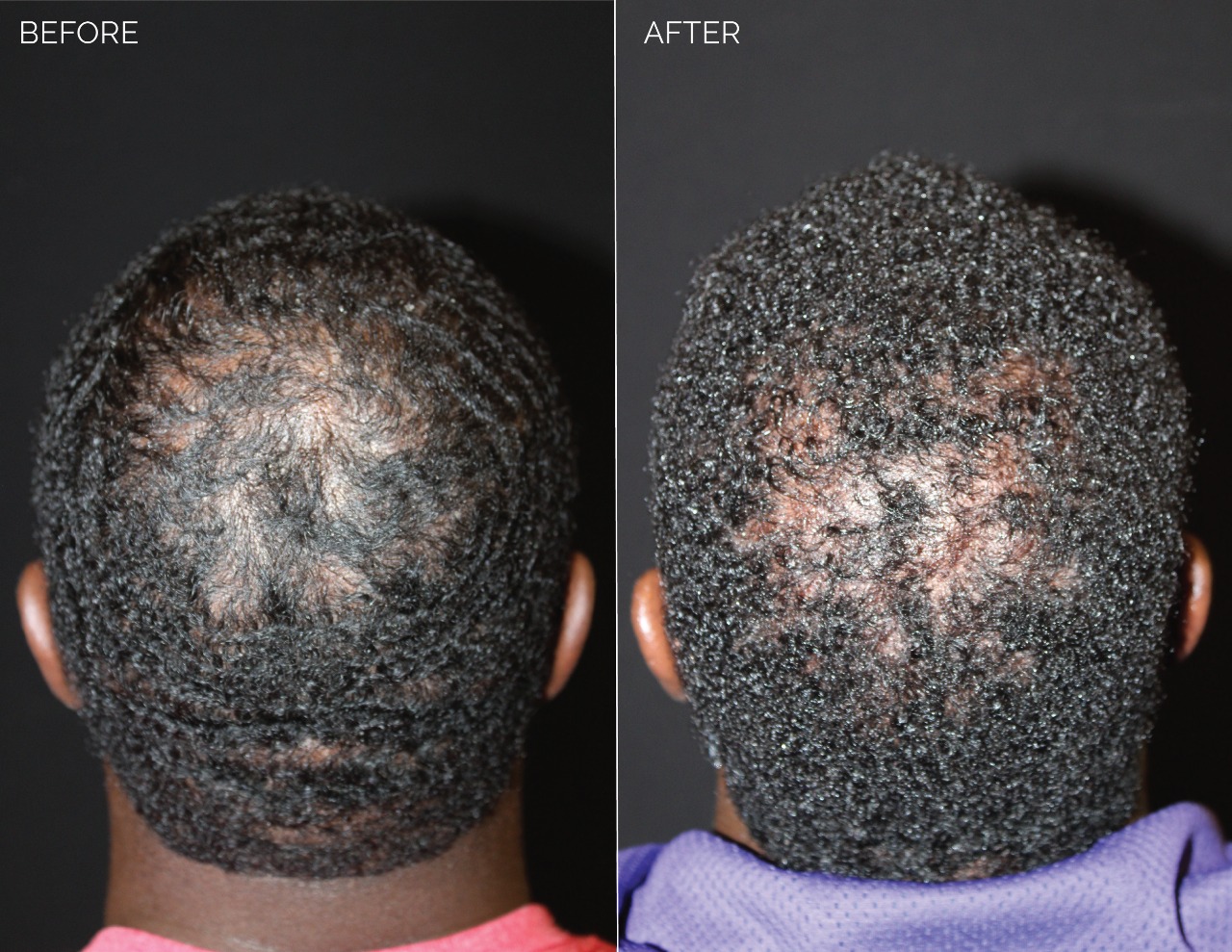 Hair Transplant UK – Safe, Professional & Effective