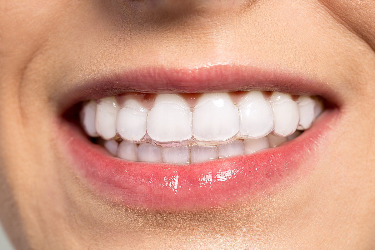 Clear Braces vs Invisalign Hawthorn Comparing Comfort, Aesthetics, and Effectiveness